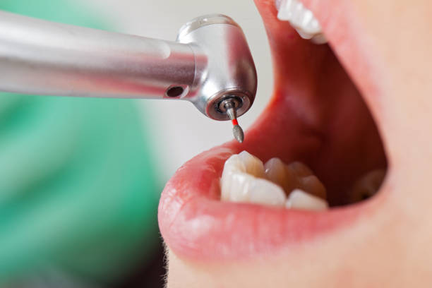 Best Emergency Dental Extractions in Philipsburg, MT